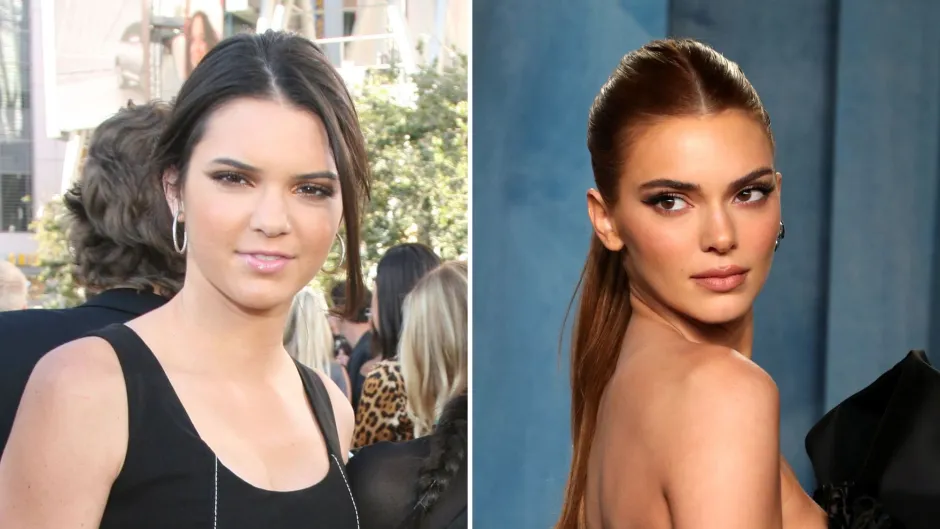 Kendall Jenner Before and After: The Transformation of a Supermodel